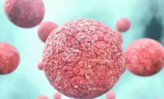 NK细胞免疫疗法联合化疗可提高晚期卵巢癌患者五年生存率