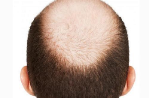 干细胞治疗脱发效果显著，再也不用秃头了