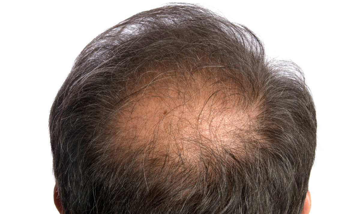 干细胞疗法：脱发的4大难点被攻破