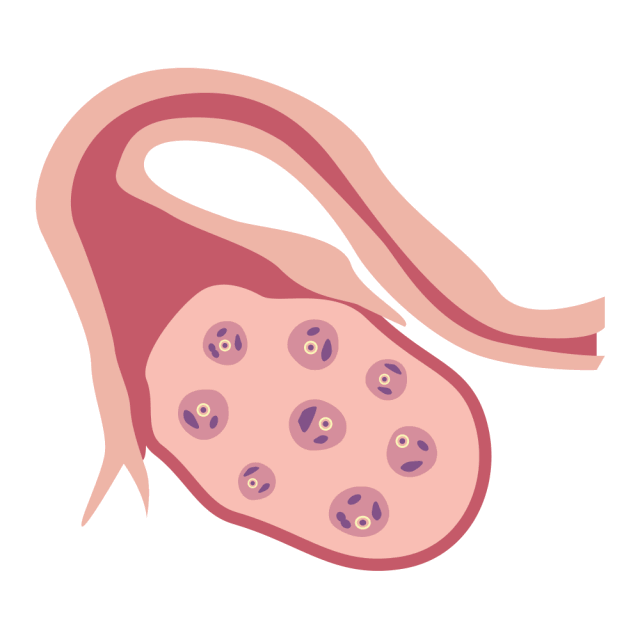 干细胞移植从根本上解决卵巢早衰
