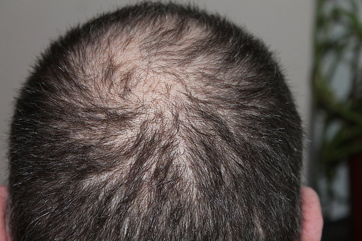 干细胞移植解决脱发的3大难题，促进毛发再生