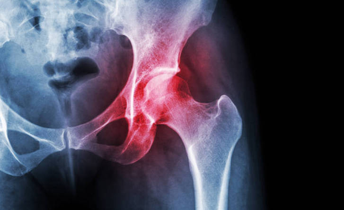 间充质干细胞治疗股骨头坏死的长期疗效分析