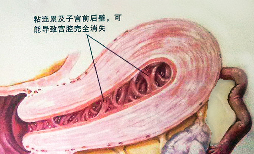 宫腔粘连