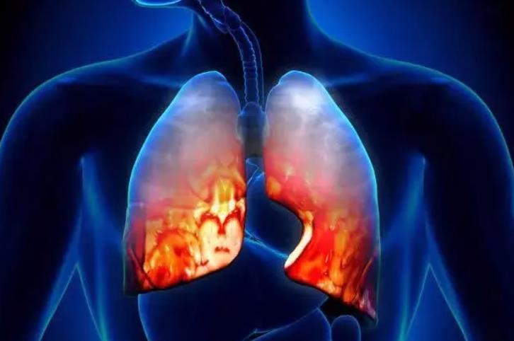干细胞与间质性肺疾病