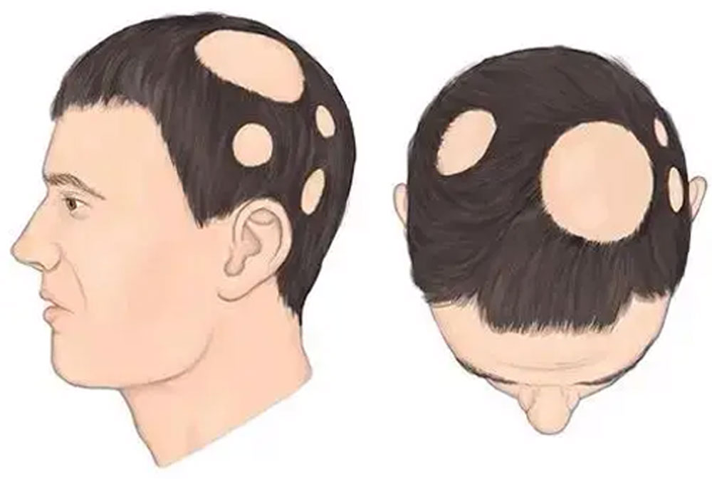 间充质干细胞在脱发中的2个研究案例