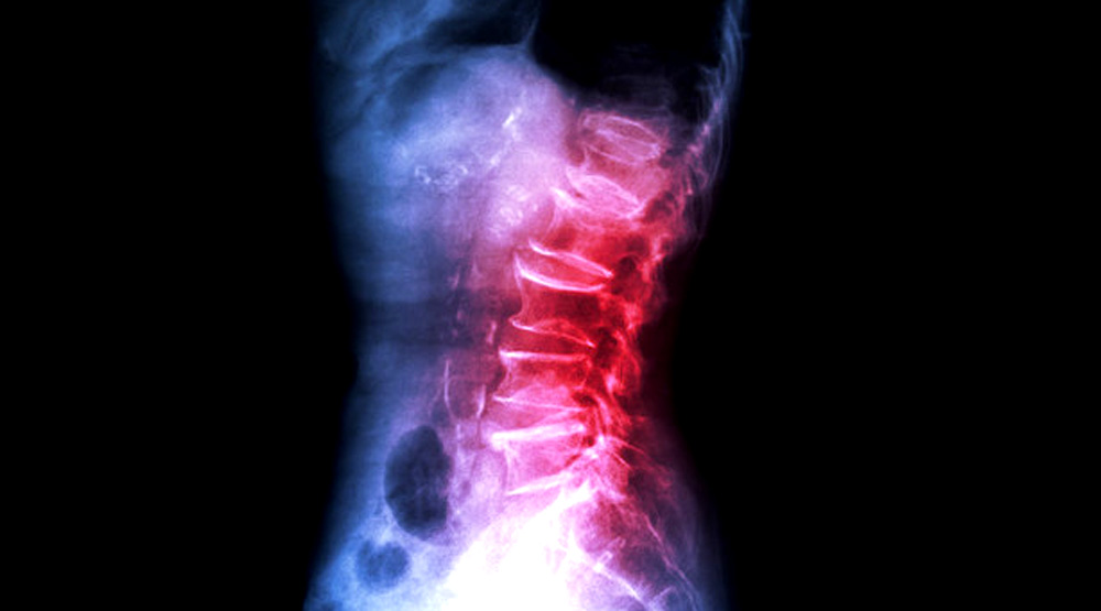 干细胞治疗42例强直性脊柱炎的应用研究