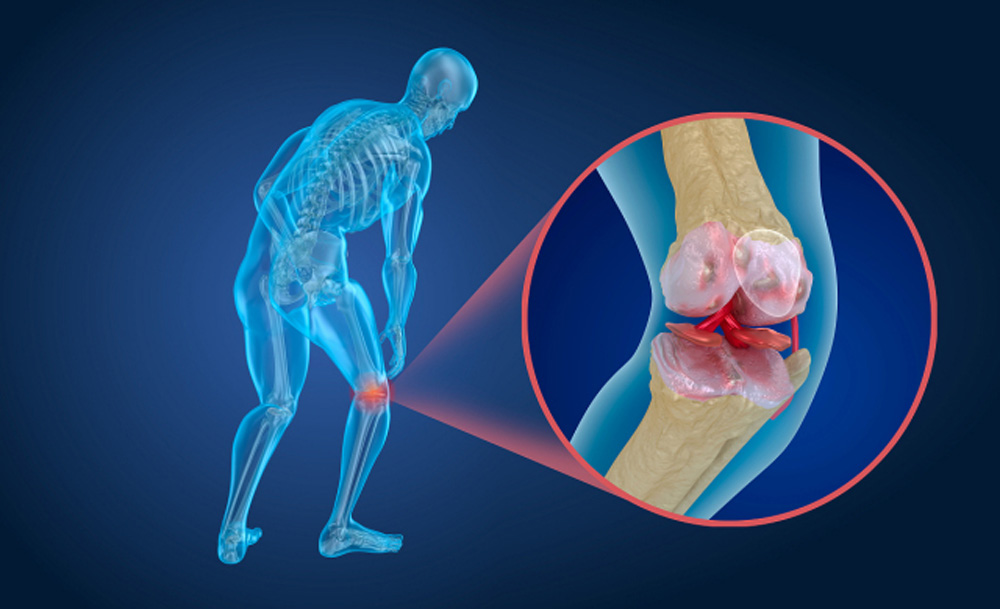干细胞治疗467例膝骨关节炎患者的中期结果和生存分析
