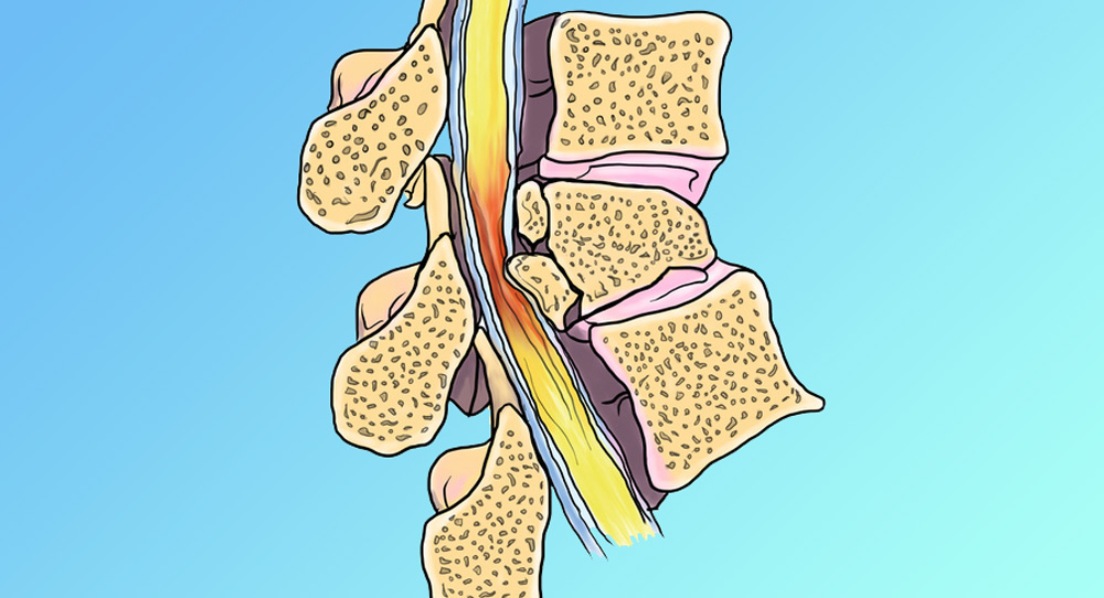 干细胞治疗脊髓损伤1例长期随访研究