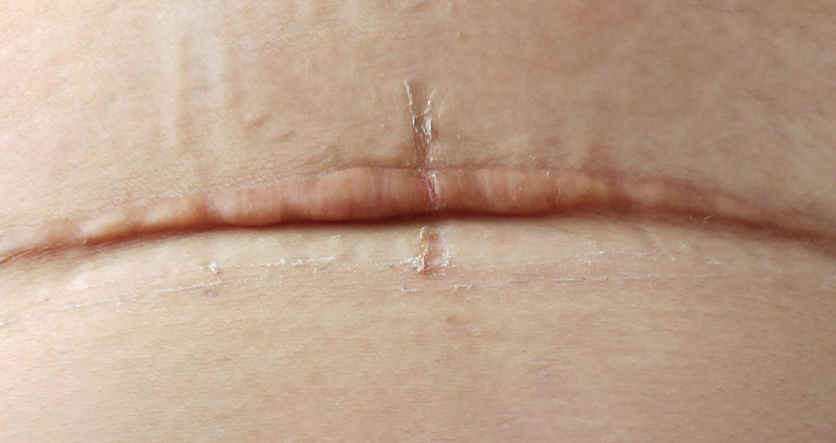 干细胞疗法在剖腹产皮肤疤痕中的应用案例分析