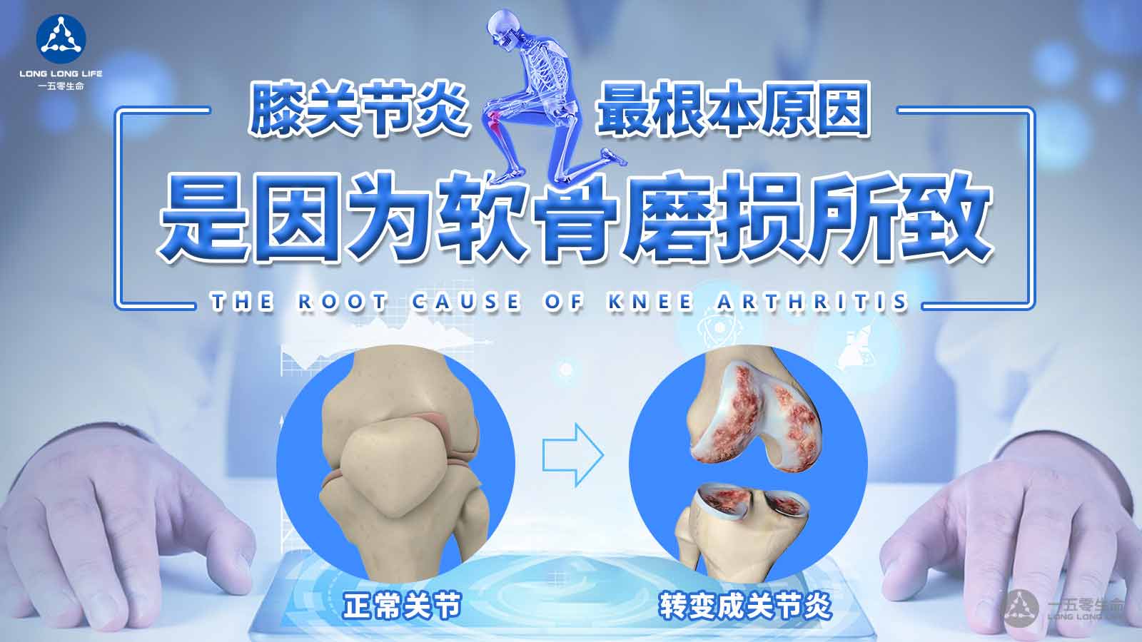 干细胞疗法调理膝关节炎效果显著
