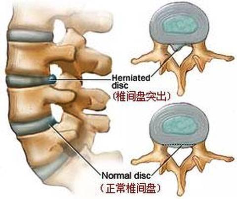 干细胞疗法治疗椎间盘退变最新临床研究