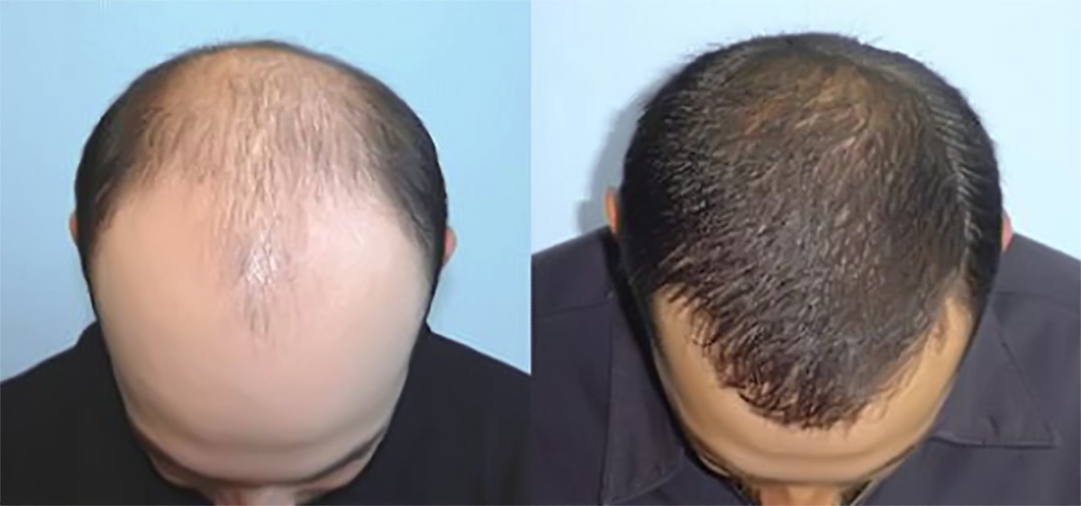干细胞治疗脱发，效果可见
