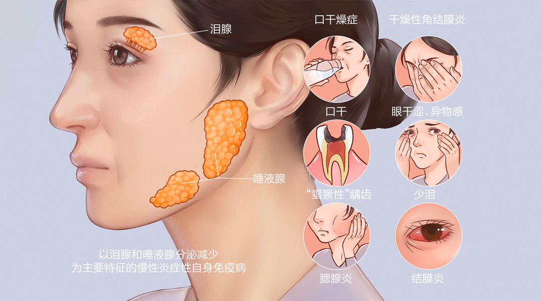 干细胞移植干燥综合征