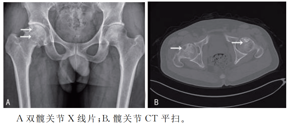干细胞治疗