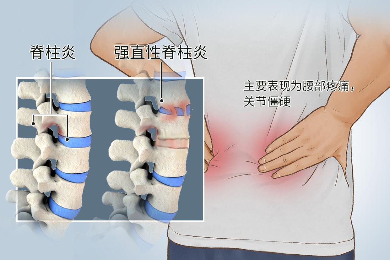 强直性脊柱炎