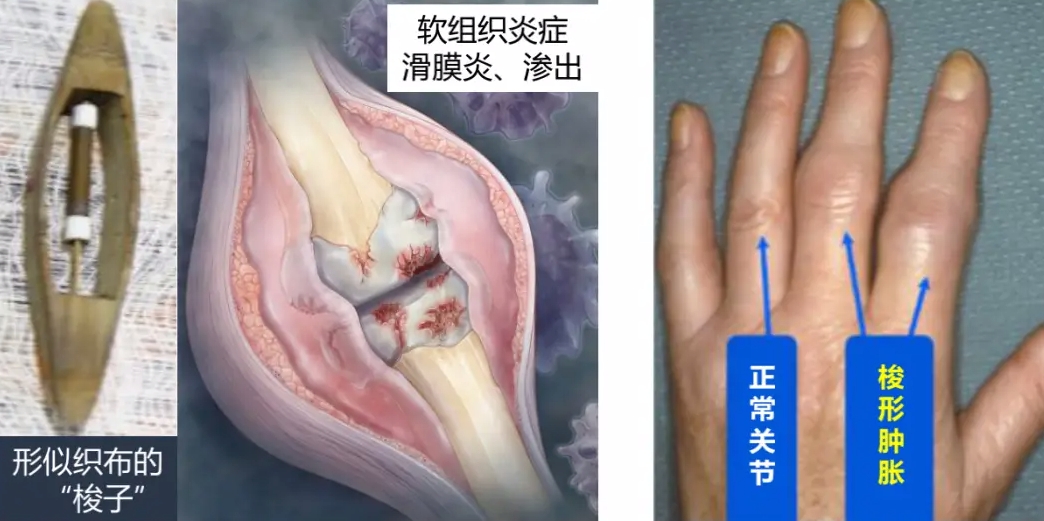 类风湿性关节炎