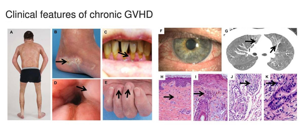 移植物抗宿主病(GVHD)