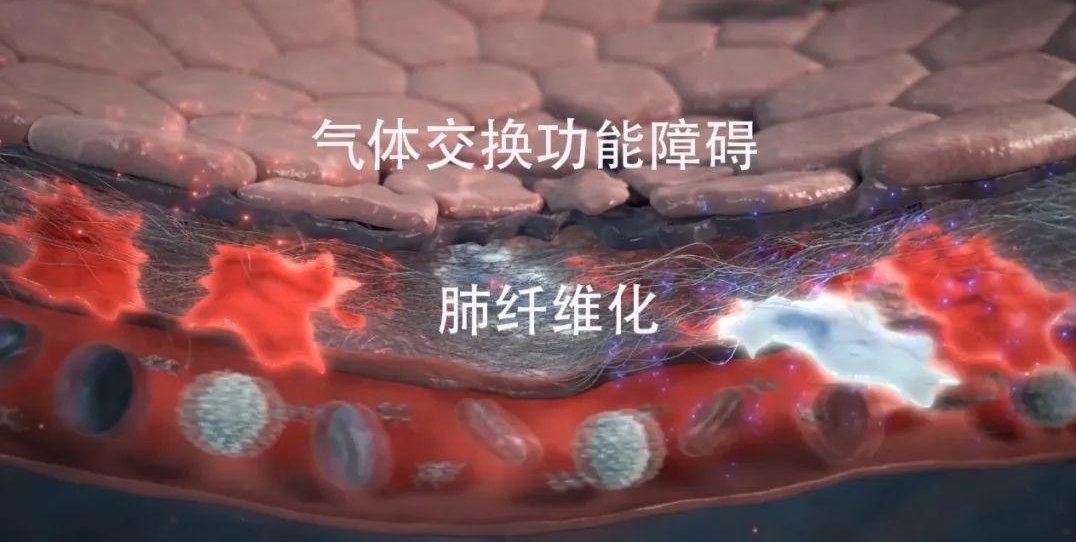 纤维化疾病