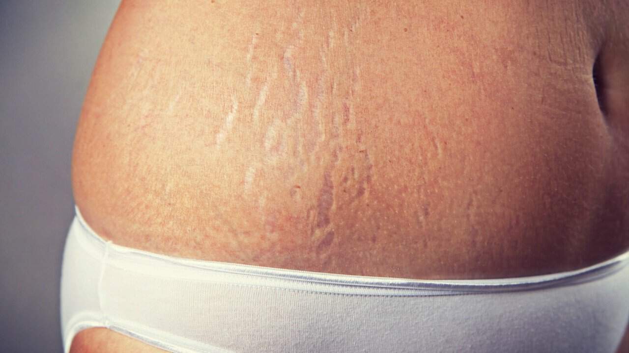 妊娠纹