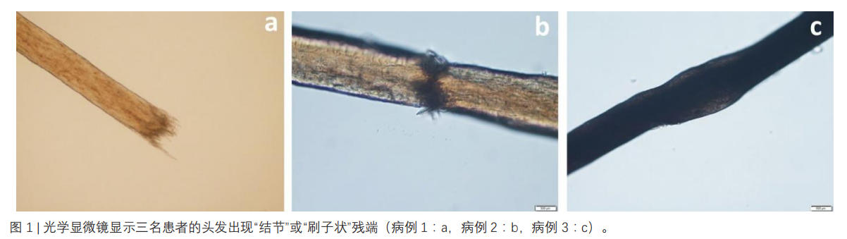 脆发症