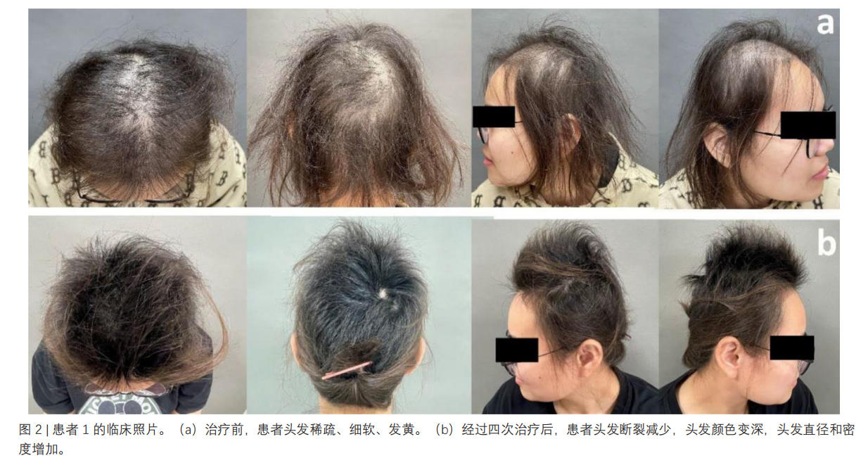 脆发症临床试验