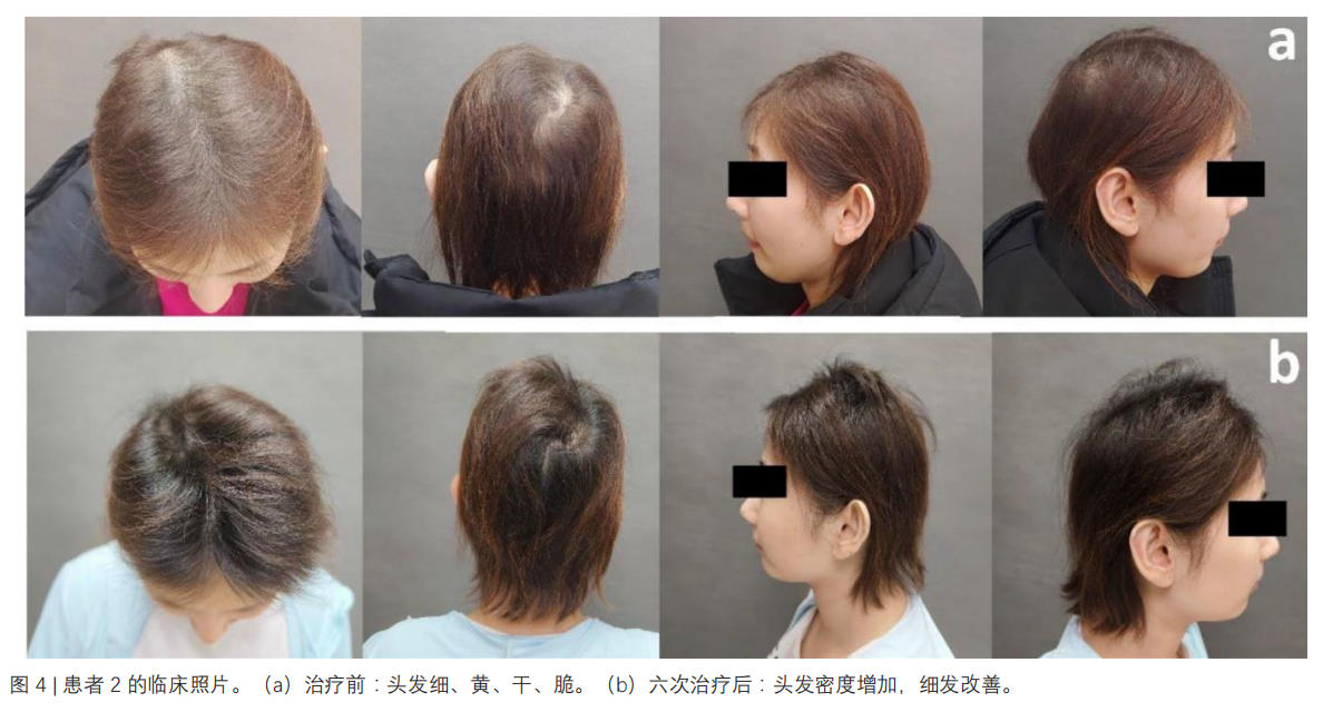 脆发症临床试验
