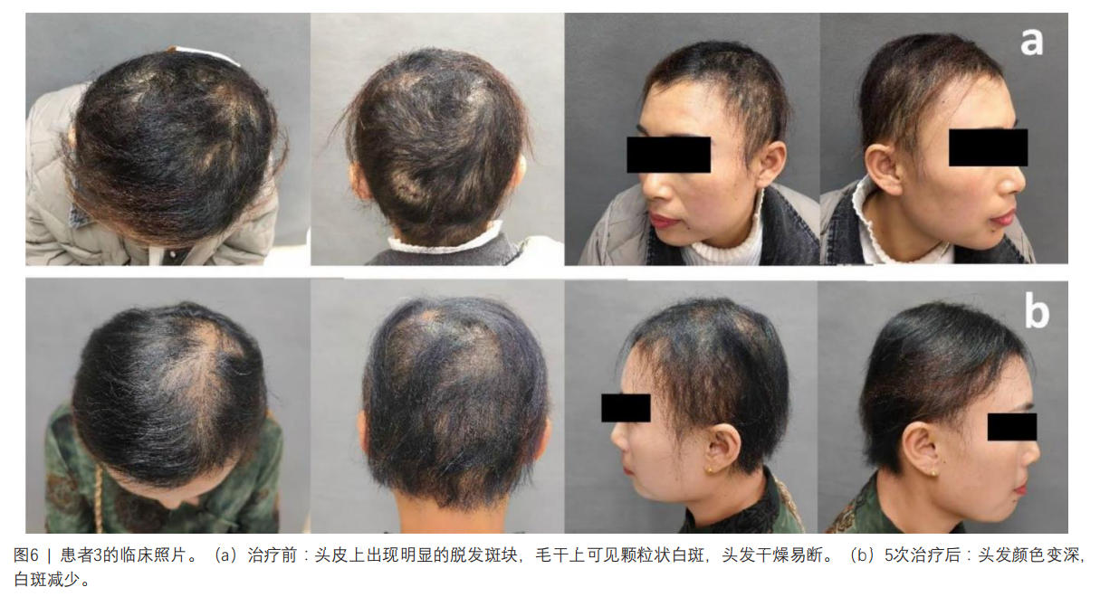脆发症临床试验