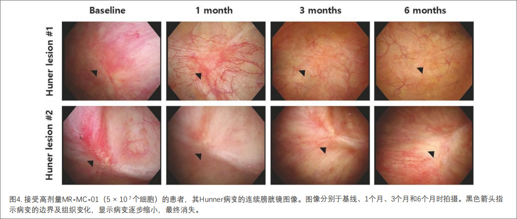 间质性膀胱炎临床试验