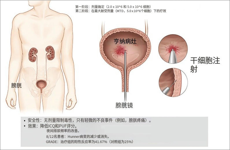 干细胞治疗