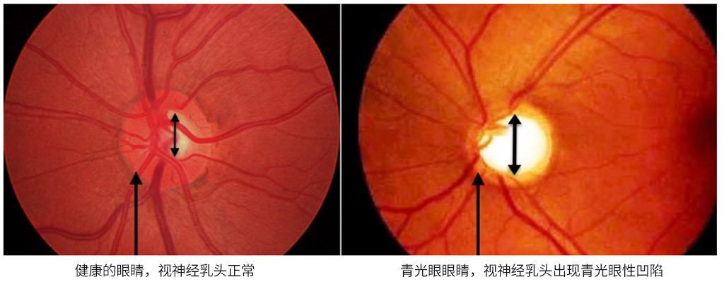 青光眼性视神经病变 青光眼性视神经病变