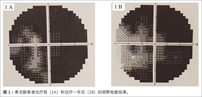 青光眼性视神经病变临床试验 青光眼性视神经病变临床试验