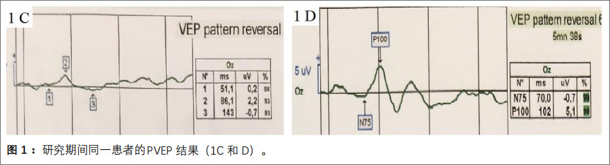 青光眼性视神经病变临床试验 青光眼性视神经病变临床试验