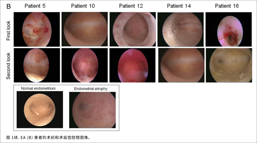 100%宫腔改善率，内膜厚度提升55.8%，妊娠率63%，干细胞治疗难治性宫腔疾病疗效显著