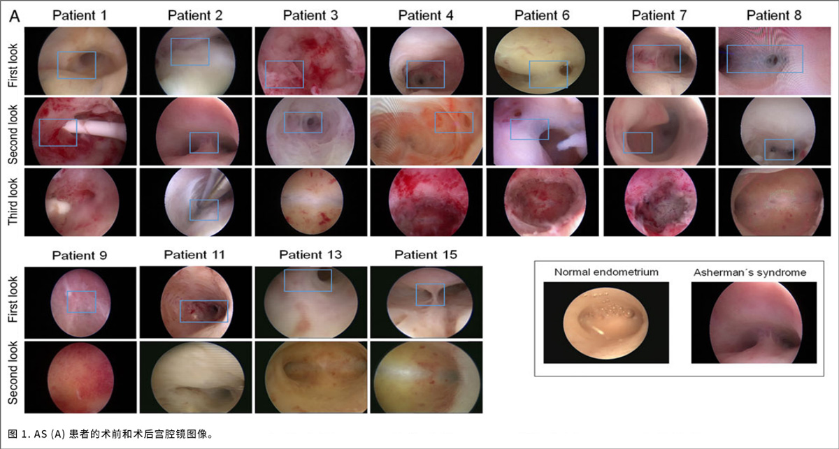 宫腔疾病临床试验