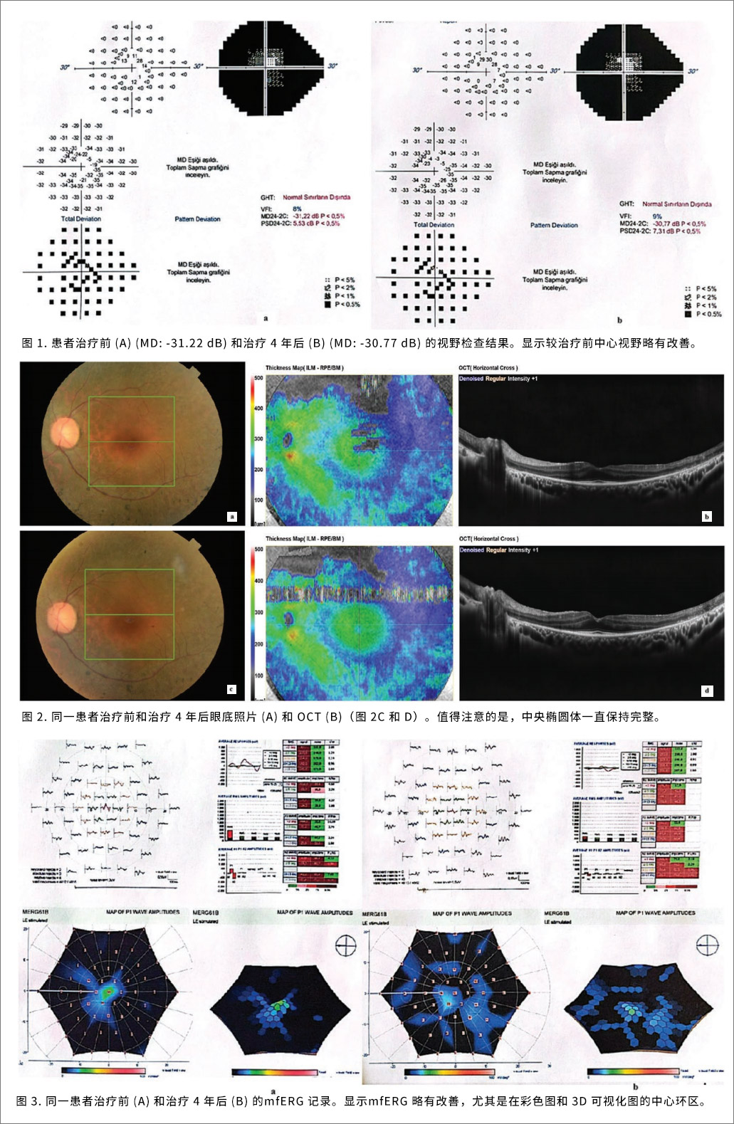 视网膜色素变性临床试验
