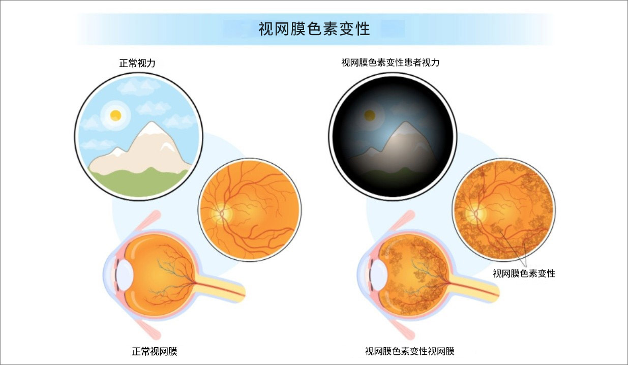 突破性研究！429例患者视力平均提升80%，干细胞疗法或可改写视网膜色素变性治疗史