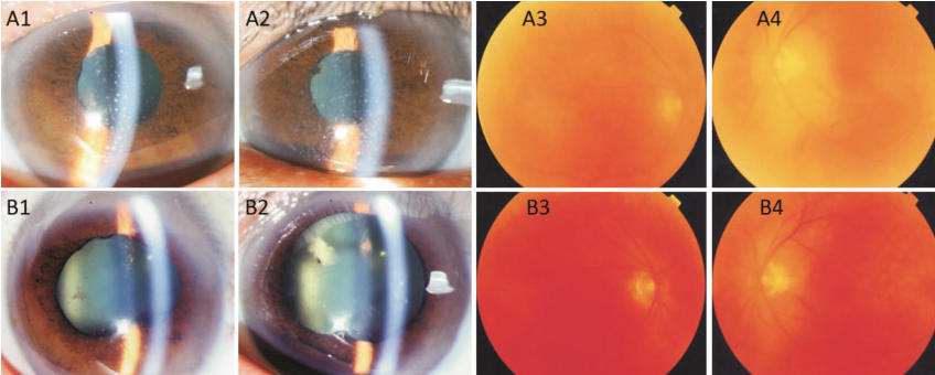 首例报道！视力提升20倍+3年无复发，干细胞或为葡萄膜炎治疗带来新希望！