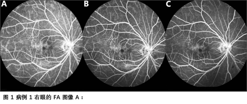 葡萄膜炎临床试验