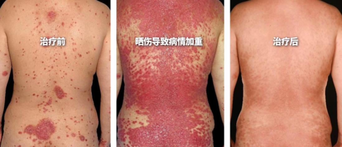 干细胞治疗银屑病新案例：3天瘙痒减轻90%，4周病情严重程度降低87%，疗效维持2年以上