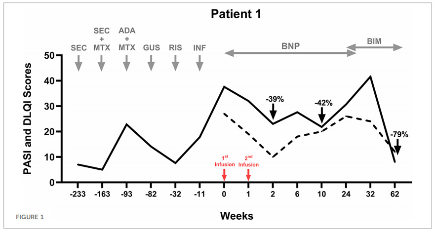 银屑病临床试验