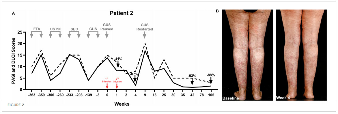 银屑病临床试验