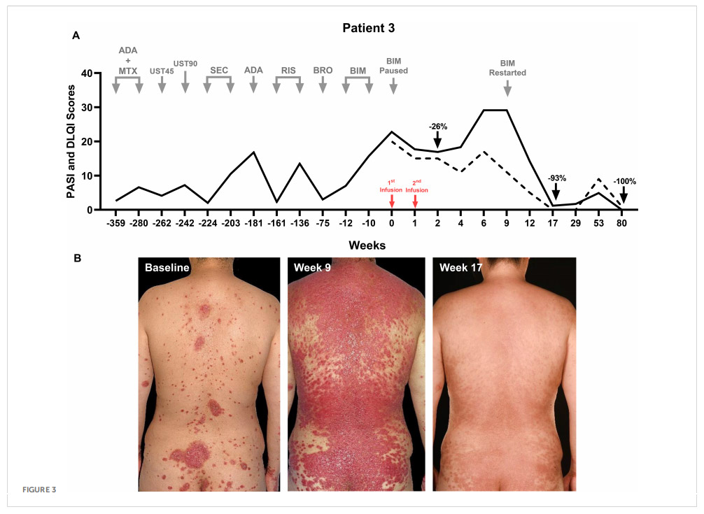 银屑病临床试验