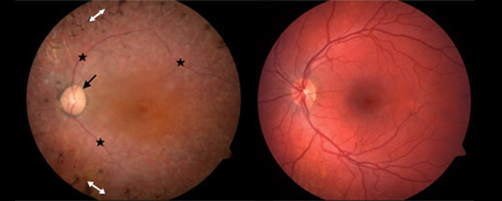 80%有效率，单眼视力最高改善94%！干细胞治疗Usher综合征5例随访报告