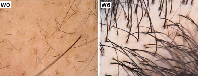 37例脱发患者输注3次干细胞分泌组后，毛发量/密度/粗细显著增加，81.08%患者非常满意