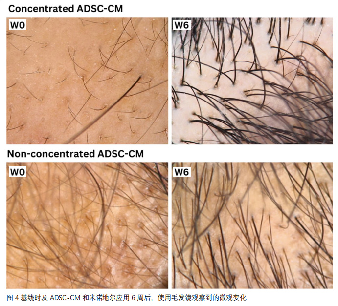 雄激素性脱发临床试验