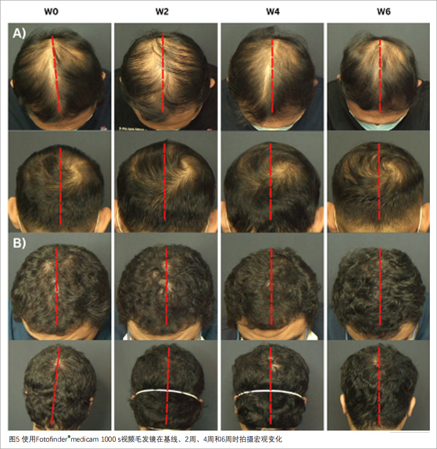 雄激素性脱发临床试验