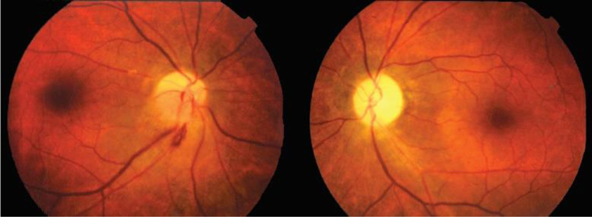 干细胞治疗复发性视神经病变：6个月视力提升367%，双眼视野显著改善