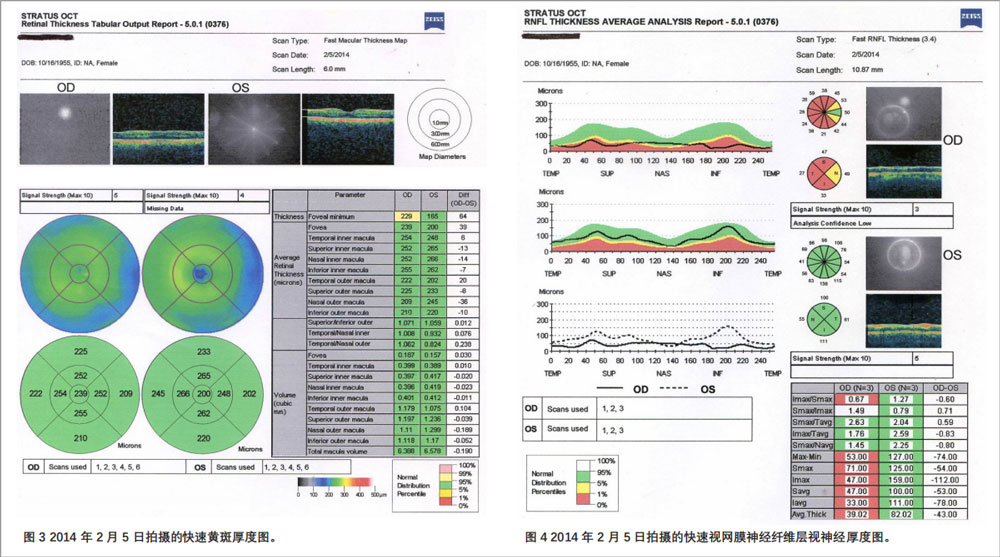 复发性视神经病变临床试验