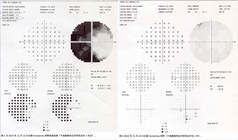 复发性视神经病变临床试验