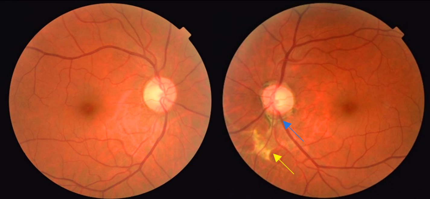 干细胞治疗创伤性视神经病变I期临床试验：术后1个月视力提升973%，较治疗前改善10.7倍！